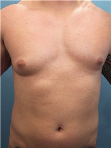 Male Breast Reduction Before Photo by Marvin Shienbaum, MD; Brandon, FL - Case 46196