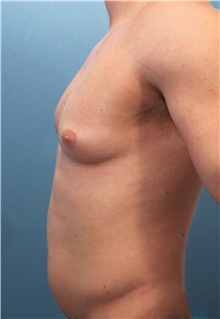 Male Breast Reduction Before Photo by Marvin Shienbaum, MD; Brandon, FL - Case 46196