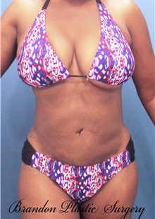 Tummy Tuck After Photo by Marvin Shienbaum, MD; Brandon, FL - Case 46197