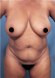 Tummy Tuck Before Photo by Marvin Shienbaum, MD; Brandon, FL - Case 46197