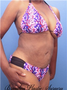 Tummy Tuck After Photo by Marvin Shienbaum, MD; Brandon, FL - Case 46197