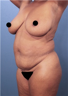 Tummy Tuck Before Photo by Marvin Shienbaum, MD; Brandon, FL - Case 46197