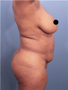 Tummy Tuck Before Photo by Marvin Shienbaum, MD; Brandon, FL - Case 46197