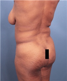 Tummy Tuck Before Photo by Marvin Shienbaum, MD; Brandon, FL - Case 46197