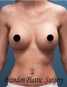 Breast Augmentation After Photo by Marvin Shienbaum, MD; Brandon, FL - Case 46198