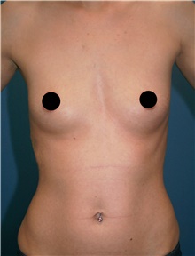 Breast Augmentation Before Photo by Marvin Shienbaum, MD; Brandon, FL - Case 46198