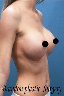 Breast Augmentation After Photo by Marvin Shienbaum, MD; Brandon, FL - Case 46198