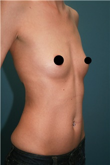 Breast Augmentation Before Photo by Marvin Shienbaum, MD; Brandon, FL - Case 46198