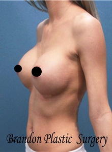 Breast Augmentation After Photo by Marvin Shienbaum, MD; Brandon, FL - Case 46198