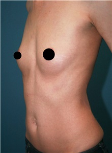 Breast Augmentation Before Photo by Marvin Shienbaum, MD; Brandon, FL - Case 46198