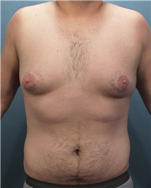 Male Breast Reduction Before Photo by Marvin Shienbaum, MD; Brandon, FL - Case 46217