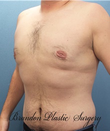 Male Breast Reduction After Photo by Marvin Shienbaum, MD; Brandon, FL - Case 46217