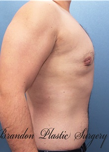 Male Breast Reduction After Photo by Marvin Shienbaum, MD; Brandon, FL - Case 46217