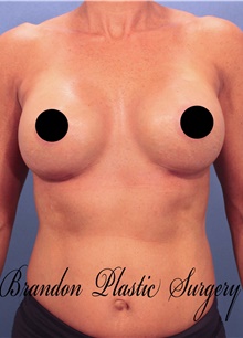 Breast Augmentation After Photo by Marvin Shienbaum, MD; Brandon, FL - Case 46218