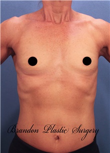 Breast Augmentation Before Photo by Marvin Shienbaum, MD; Brandon, FL - Case 46218