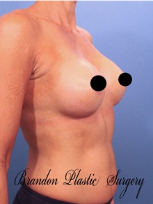 Breast Augmentation After Photo by Marvin Shienbaum, MD; Brandon, FL - Case 46218