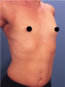 Breast Augmentation Before Photo by Marvin Shienbaum, MD; Brandon, FL - Case 46218