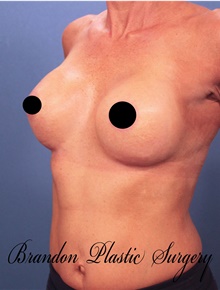 Breast Augmentation After Photo by Marvin Shienbaum, MD; Brandon, FL - Case 46218