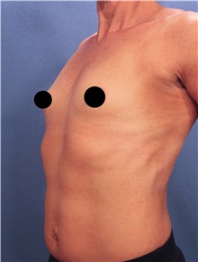 Breast Augmentation Before Photo by Marvin Shienbaum, MD; Brandon, FL - Case 46218