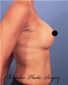 Breast Augmentation After Photo by Marvin Shienbaum, MD; Brandon, FL - Case 46218