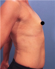 Breast Augmentation Before Photo by Marvin Shienbaum, MD; Brandon, FL - Case 46218