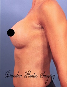 Breast Augmentation After Photo by Marvin Shienbaum, MD; Brandon, FL - Case 46218