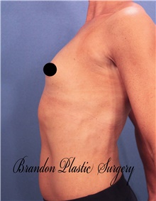 Breast Augmentation Before Photo by Marvin Shienbaum, MD; Brandon, FL - Case 46218