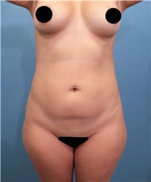 Liposuction Before Photo by Marvin Shienbaum, MD; Brandon, FL - Case 46221