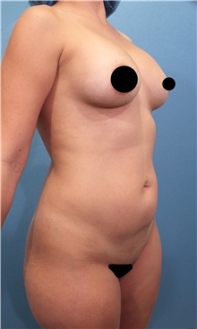 Liposuction Before Photo by Marvin Shienbaum, MD; Brandon, FL - Case 46221