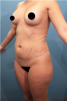 Liposuction Before Photo by Marvin Shienbaum, MD; Brandon, FL - Case 46221