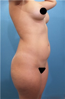 Liposuction Before Photo by Marvin Shienbaum, MD; Brandon, FL - Case 46221