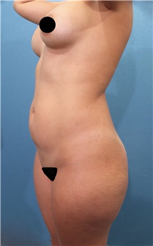 Liposuction Before Photo by Marvin Shienbaum, MD; Brandon, FL - Case 46221