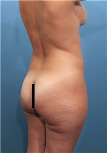 Liposuction Before Photo by Marvin Shienbaum, MD; Brandon, FL - Case 46221