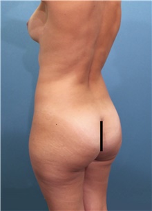 Liposuction Before Photo by Marvin Shienbaum, MD; Brandon, FL - Case 46221