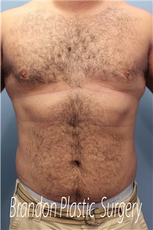 Male Breast Reduction After Photo by Marvin Shienbaum, MD; Brandon, FL - Case 46223