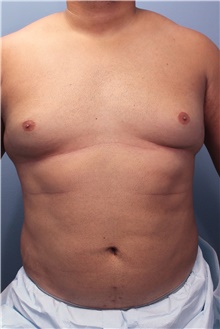 Male Breast Reduction Before Photo by Marvin Shienbaum, MD; Brandon, FL - Case 46223