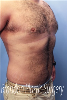 Male Breast Reduction After Photo by Marvin Shienbaum, MD; Brandon, FL - Case 46223