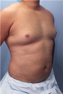 Male Breast Reduction Before Photo by Marvin Shienbaum, MD; Brandon, FL - Case 46223