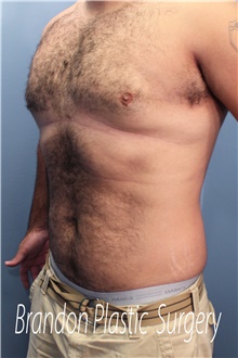 Male Breast Reduction After Photo by Marvin Shienbaum, MD; Brandon, FL - Case 46223