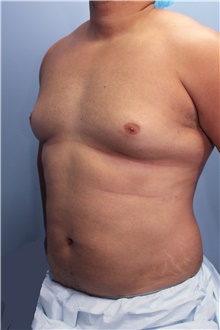 Male Breast Reduction Before Photo by Marvin Shienbaum, MD; Brandon, FL - Case 46223