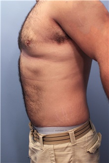 Male Breast Reduction After Photo by Marvin Shienbaum, MD; Brandon, FL - Case 46223