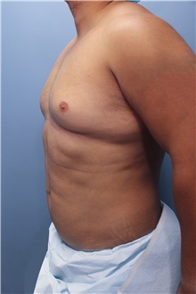 Male Breast Reduction Before Photo by Marvin Shienbaum, MD; Brandon, FL - Case 46223