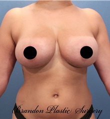 Breast Lift After Photo by Marvin Shienbaum, MD; Brandon, FL - Case 46225