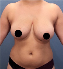 Breast Lift Before Photo by Marvin Shienbaum, MD; Brandon, FL - Case 46225