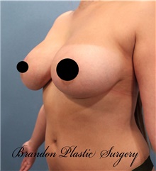 Breast Lift After Photo by Marvin Shienbaum, MD; Brandon, FL - Case 46225