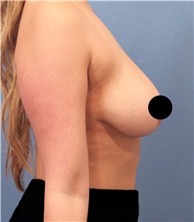 Breast Lift Before Photo by Marvin Shienbaum, MD; Brandon, FL - Case 46225