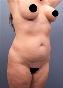 Liposuction Before Photo by Marvin Shienbaum, MD; Brandon, FL - Case 46266