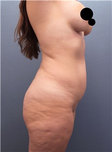 Liposuction Before Photo by Marvin Shienbaum, MD; Brandon, FL - Case 46266