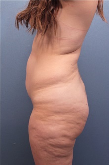 Liposuction Before Photo by Marvin Shienbaum, MD; Brandon, FL - Case 46266