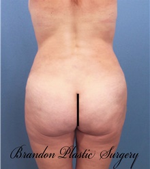 Buttock Lift with Augmentation After Photo by Marvin Shienbaum, MD; Brandon, FL - Case 46357